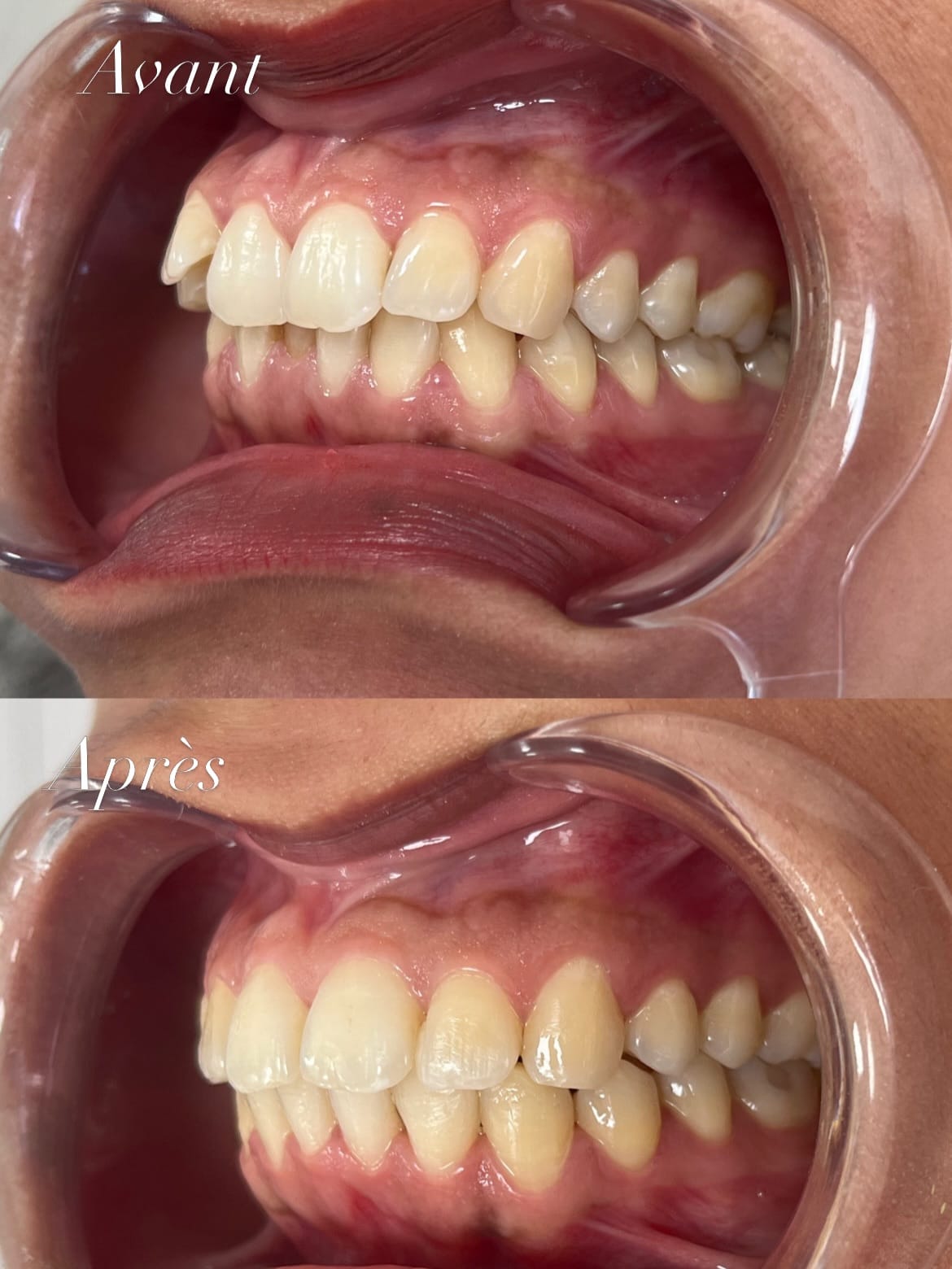 Le même cas d’orthodontie vu de profil, avant et après : les dents du haut et du bas s’emboîtent mieux après le traitement.